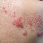 Shingles vaccine recommended for those 50 years and older