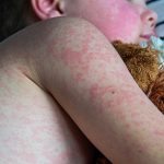 Measles making a comeback in the U.S.