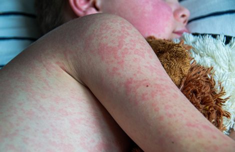 Measles rash on the body of a child.
