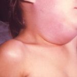 Four mumps cases reported in Garfield County