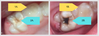 tooth before and after SDF
