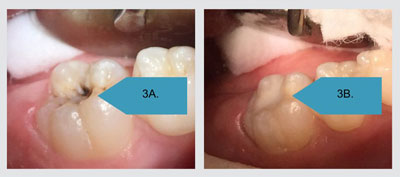 tooth before sdf and after showing improvement